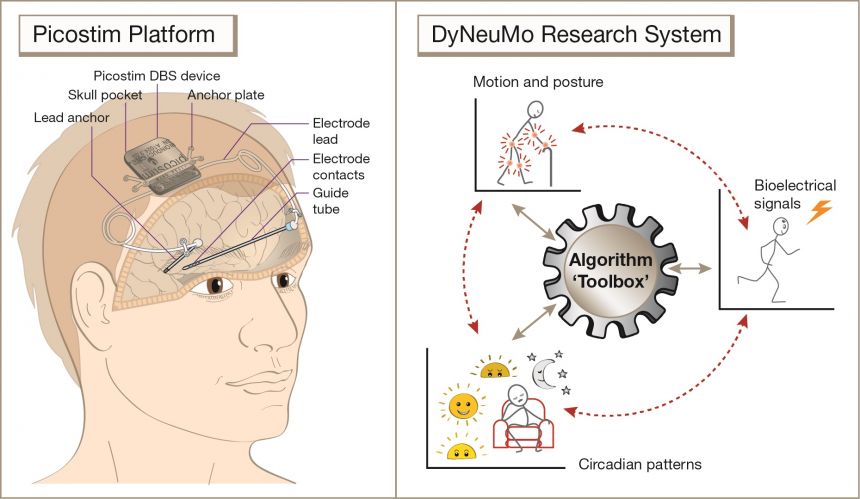 First-in-human implant of a “closed-loop” bioelectronic research system for investigating treatments for brain disorders