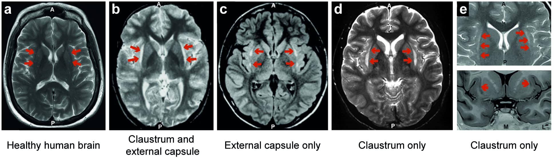 Little understood brain region linked to how we perceive pain