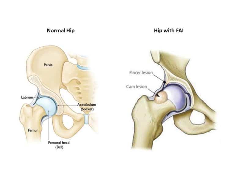 An image showing the anatomy of the hip joint