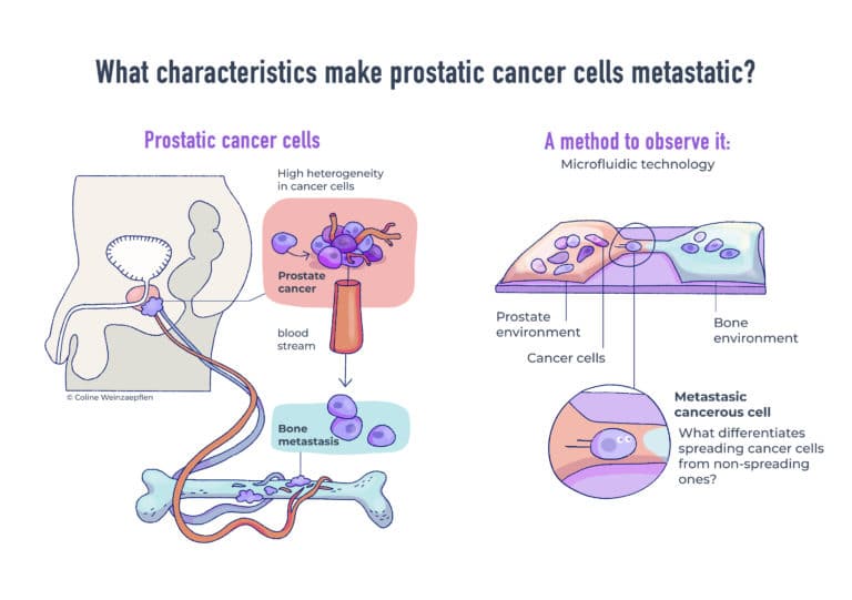 "What characteristics make prostatic cancer cells metastatic?" cartoon. By Coline Weinzaepflen.