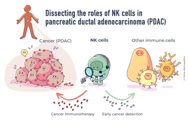 Drawing of "Dissecting the roles of NK cells in pancreatic ductal adenocarcinoma (PDAC)" by Coline Weinzaepflen.