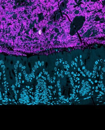 Bacteria are seen as a layer of pink squiggle-like shapes above a wall of spongy human gut cells underneath.