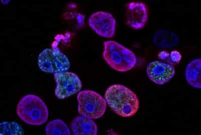 Colorectal cancer cells, with the nuclei stained blue. Created by Yves Pommier, Rozenn Josse, 2014. Image from the National Cancer Institute.