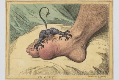 'The Gout', a Georgian caricature by James Gillray (1799).